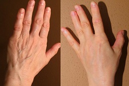 تجميل اليدين في الرياض