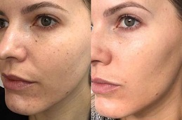 تحسين البشرة في الرياض والمملكة العربية السعودية