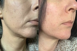 تحسين البشرة في الرياض