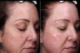 تحليل البشرة بتقنية VISIA في الرياض والمملكة العربية السعودية