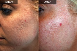 تحليل البشرة بتقنية VISIA في الرياض