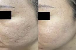 ترددات الراديو لعلاج ندبات حب الشباب في الرياض