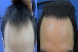 تركيب الشعر في خط المواجهة بالرياض والمملكة العربية السعودية