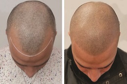 تصبغ فروة الرأس الدقيق في الرياض والمملكة العربية السعودية