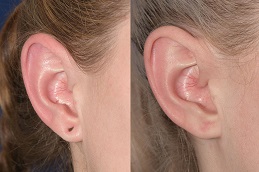 تصحيح شحمة الأذن في الرياض