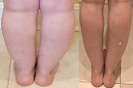 تصغير الساق في الرياض والمملكة العربية السعودية