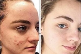 تقشير البشرة بالتوهج في الرياض والمملكة العربية السعودية