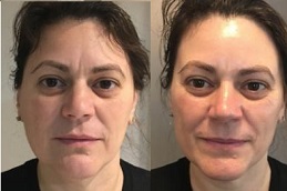 تقشير البشرة بالتوهج في الرياض