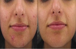 تقشير الماندليك في الرياض والمملكة العربية السعودية