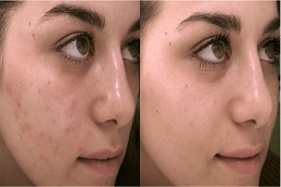 تقشير الماندليك في الرياض