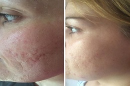 تقشير حمض الجليكوليك في الرياض والمملكة العربية السعودية