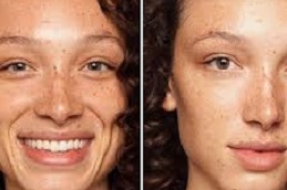 تقشير حمض الجليكوليك في الرياض