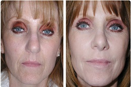 تقشير ماسي في الرياض والمملكة العربية السعودية