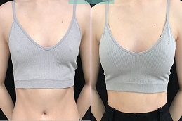 تكبير الثدي بدون ندوب في الرياض والمملكة العربية السعودية