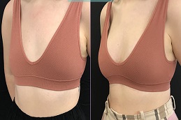 تكبير الثدي بدون ندوب في الرياض