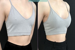 تكبير الثدي مع ندبة قصيرة في الرياض والمملكة العربية السعودية