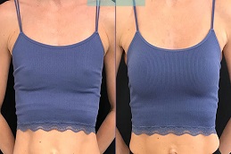 تكبير الثدي مع ندبة قصيرة في الرياض