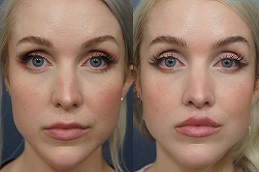 تكبير الشفاه في الرياض والمملكة العربية السعودية