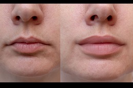 تكبير الشفاه في الرياض