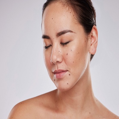 تكلفة إزالة الشامات في الرياض