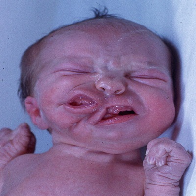 تكلفة التشوهات الخلقية في الرياض