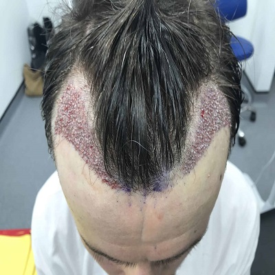 تكلفة زراعة الشعر 4000 أو 5000 بصيلة
