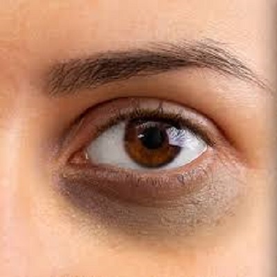 تكلفة علاج الهالات السوداء في الرياض