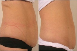 تنشيط العضلات الديناميكي (DMA) في الرياض