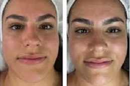 تنظيف عميق للوجه في الرياض والمملكة العربية السعودية