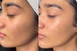 تنظيف عميق للوجه في الرياض