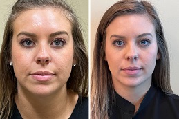 تنعيم التجاعيد في الرياض والمملكة العربية السعودية