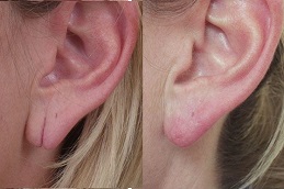 ثقب الأذن في الرياض