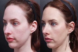 جراحة الأنف بالسيليكون في الرياض والمملكة العربية السعودية