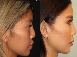 جراحة الأنف بالسيليكون في الرياض