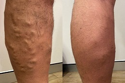 جراحة الأوعية الدموية في الرياض والمملكة العربية السعودية