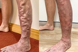 جراحة الأوعية الدموية في الرياض