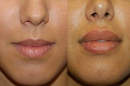 جراحة تصغير الشفاه في الرياض والمملكة العربية السعودية