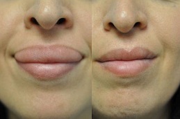 جراحة تصغير الشفاه في الرياض