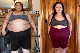 جراحة حصوات المرارة في الرياض