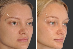 جراحة رفع الحاجب في الرياض والمملكة العربية السعودية