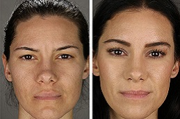 جراحة رفع الحاجب في الرياض