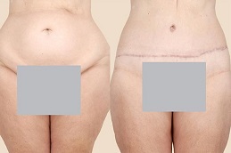 جراحة شفط الدهون في جدة