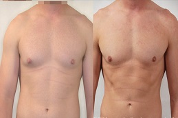 جراحة شفط دهون الصدر في الرياض