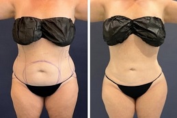 جراحة شفط دهون في جدة والمملكة العربية السعودية