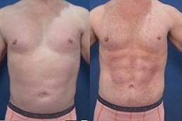 جراحة عضلات البطن في الرياض والمملكة العربية السعودية