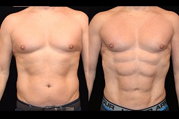 جراحة عضلات البطن في الرياض