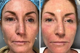 جلسة أكواغولد فاين تاتش للوجه في الرياض والمملكة العربية السعودية