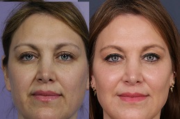 حشو الخدود في الرياض والمملكة العربية السعودية