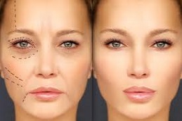 حشو الخدود في الرياض