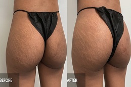 حشوات المؤخرة في الرياض